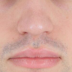 Labio superior - Hombre